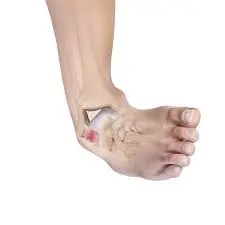 Ankle-instability