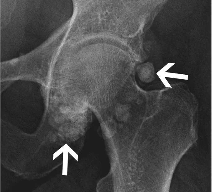 calcification