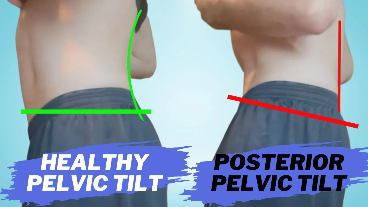 posterir-pelvic-tilt