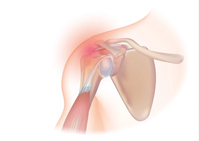 shoulder-Tendonitis