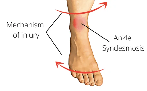 Syndesmotic Ankle Sprain Cause Symptoms Treatment Syndesmotic Ankle Sprain Cause Symptoms Treatment