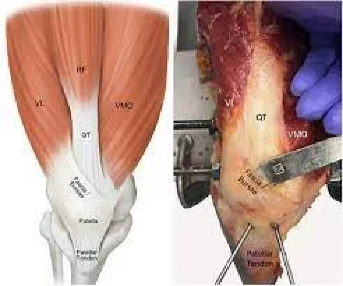 The landmarks and boundaries for fascia lata harvest are shown. The