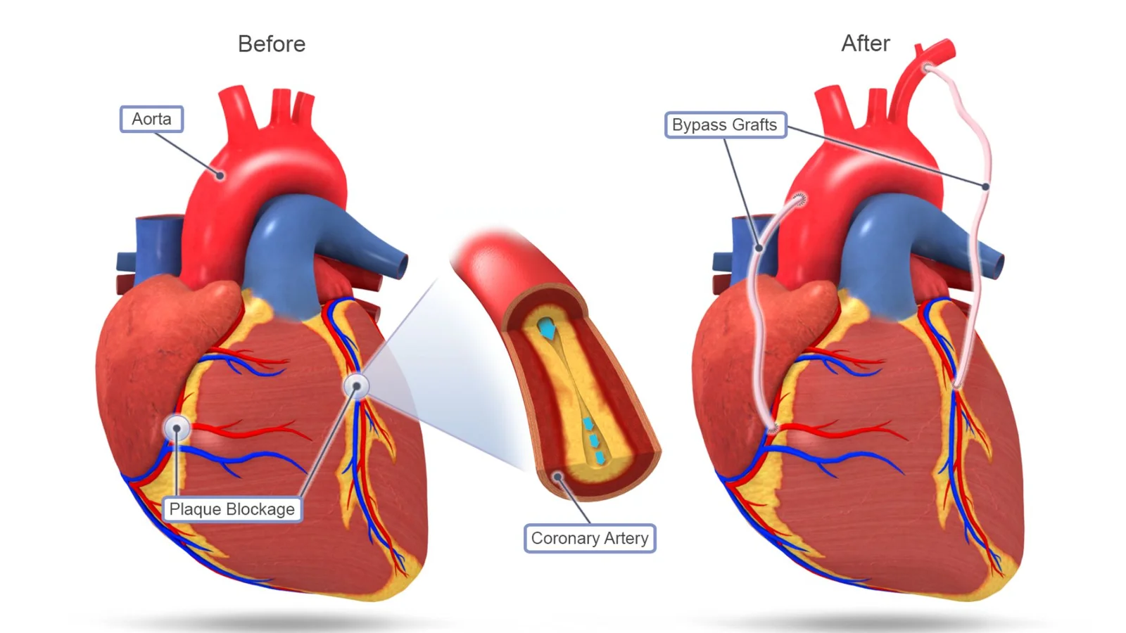 Coronary Artery Bypass Surgery - Procedure, Recovery & Risks