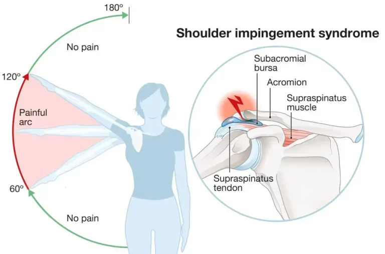 Pain full arc test