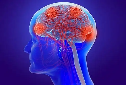 Metabolic Encephalopathy