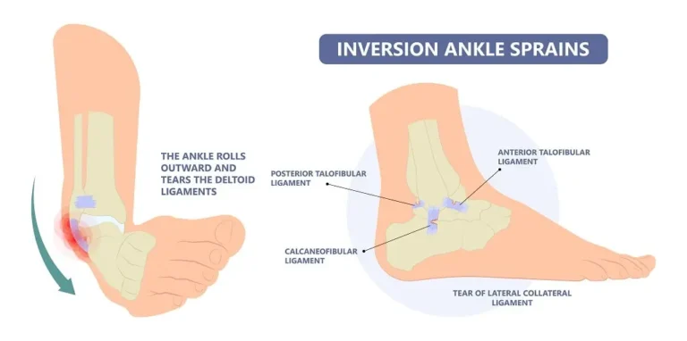 Inversion Ankle Sprain
