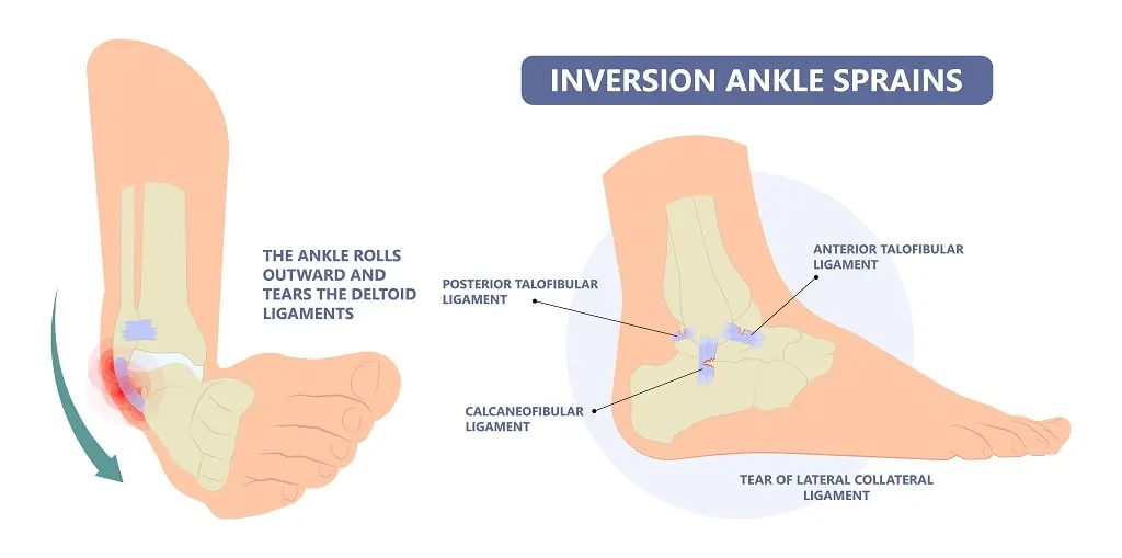 Inversion Ankle Sprain